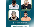 best hair transplant clinic in Rajasthan